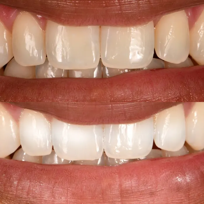 Before and after POOOF! whitening, before on top