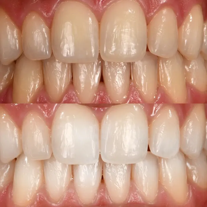 Before and after POOOF! whitening, before on top