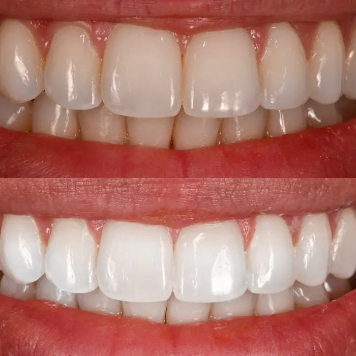 Before and after POOOF! whitening, before on top