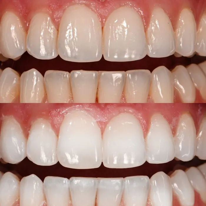 Before and after POOOF! whitening, before on top
