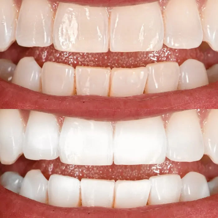 Before and after POOOF! whitening, before on top