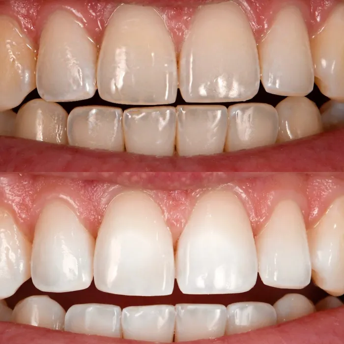 Before and after POOOF! whitening, before on top
